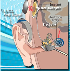 Tecnologia en aparato auditivo que ayuda a muchos con problemas de audicion