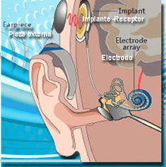 LOS APARATOS AUDITIVOS PUEDEN AYUDAR A LAS PERSONAS CON PERDIDA AUDITIVA A  VIVIR MÁS TIEMPO