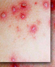chicken pox blisters
